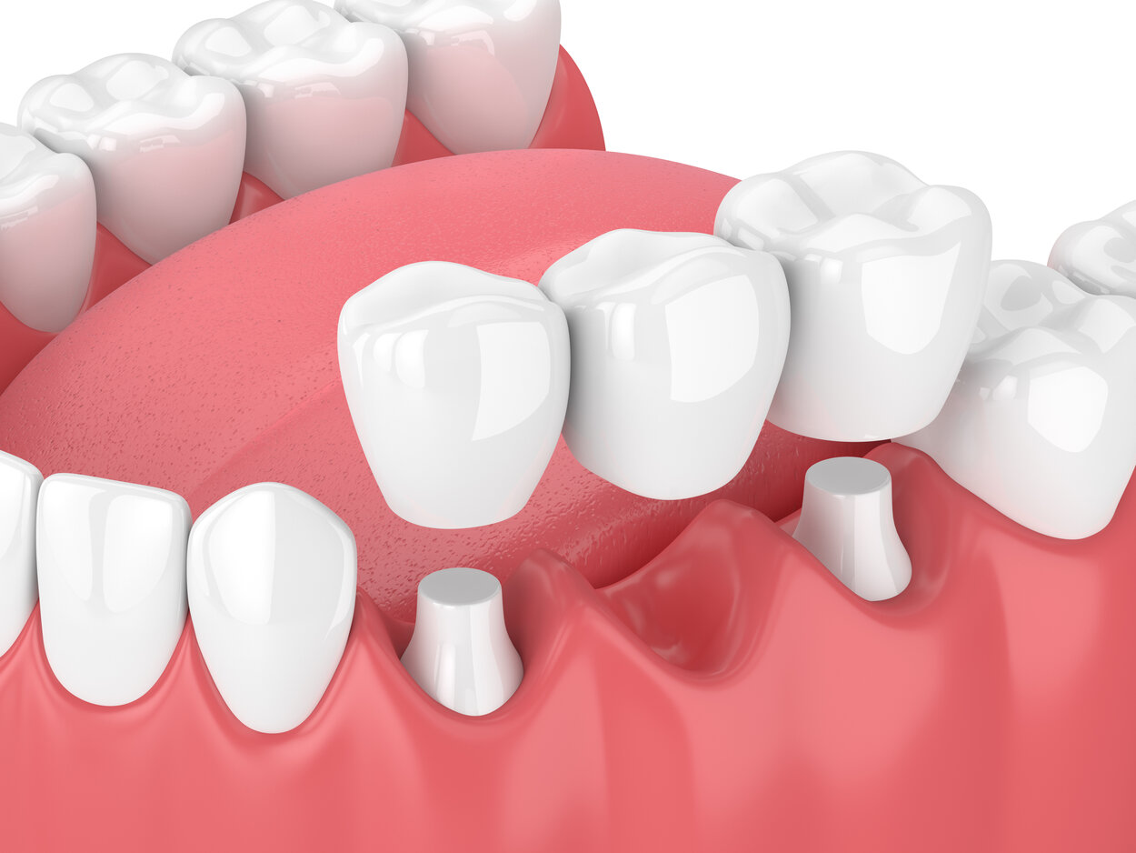 How to Fix a Cracked Dental Bridge? - Sue Vetter, DDS | Seattle